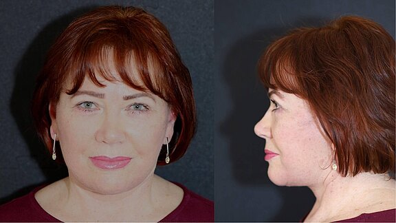 Facelift Nachher